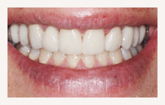 Porcelain Veneers