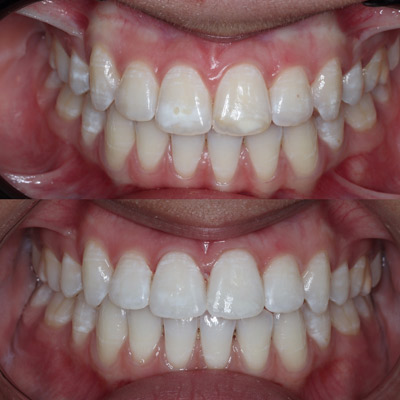before and after white spot treatment