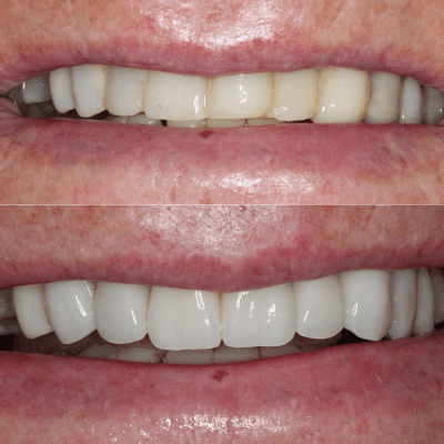 Before and After Crowns at Serene Smiles Perth