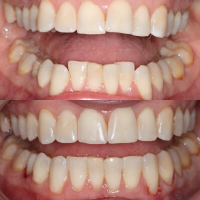 invisalign crowding before and after