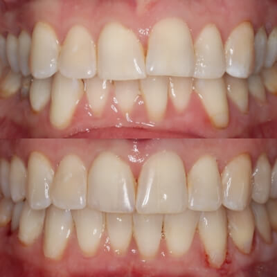 invisalign crowding before and after