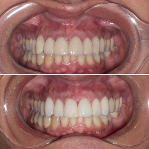 before and after veneers