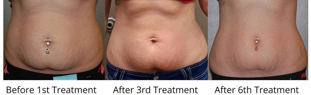 Body Contouring After Weight Loss Before and After Pictures Case 77, Albany & Latham, New York