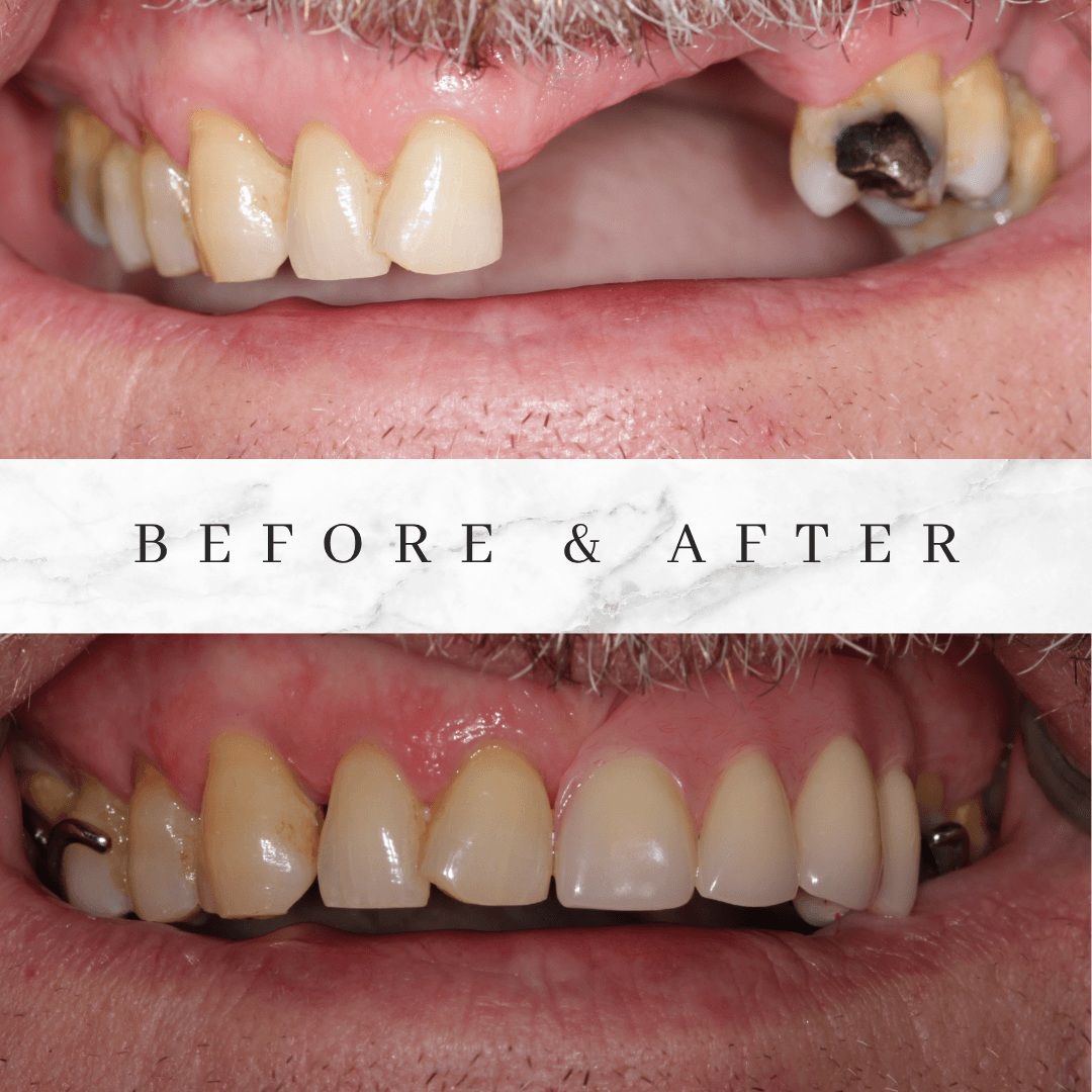 implant-before-and-after