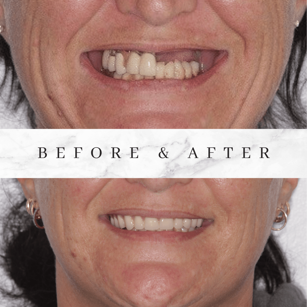 implants before and after lady