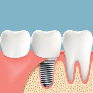 dental implants