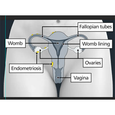  Endometriosis: photo credit : NHS