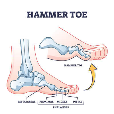 hammer-toe