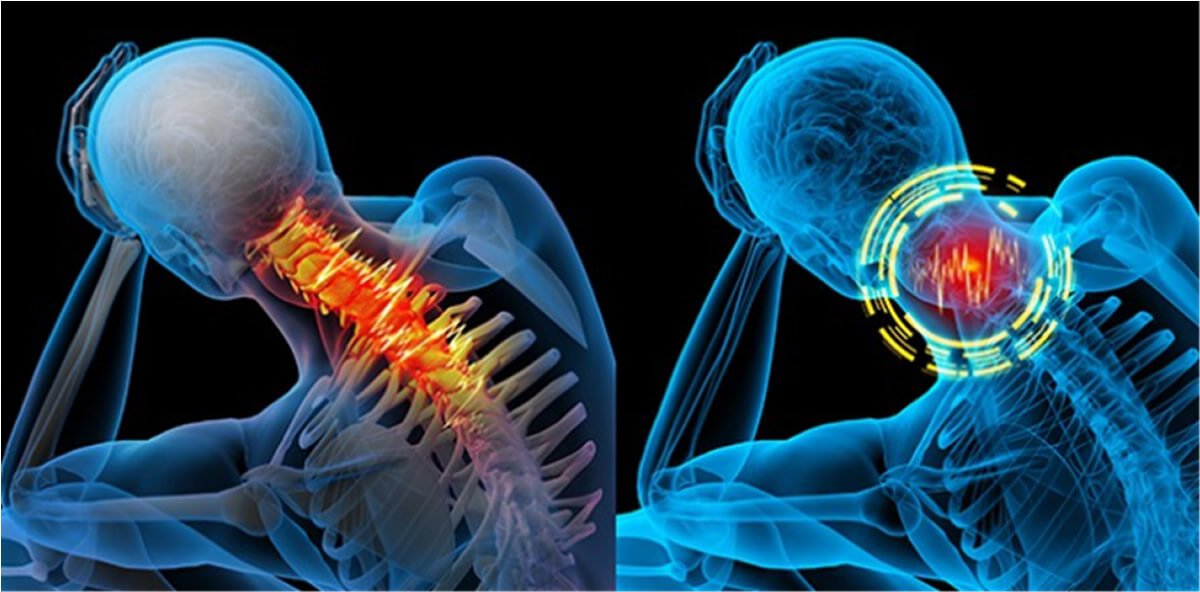 Illustration of brain and neck pain