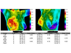 Breast Thermography Milford, Hamden, Newington CT