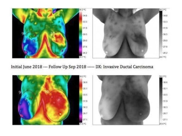 PET, CT Scans, and Thermagraphy for Breast Cancer Imaging