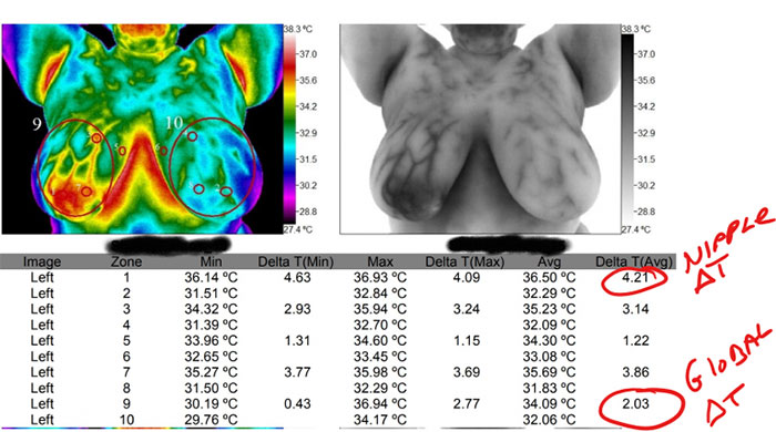 Quantitative thermographic signs nipplear heat: encircled areas show