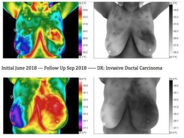 Breast scan followup
