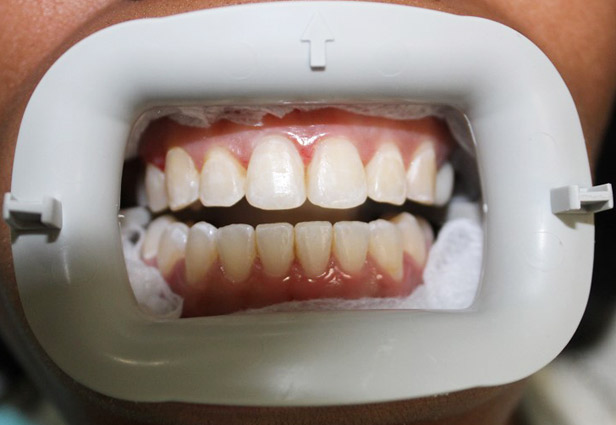 Teeth whitening 2 Before
