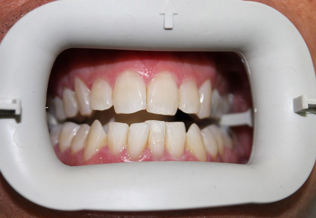 Teeth whitening 3 Before