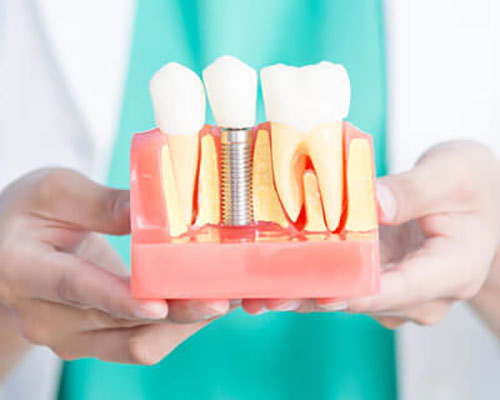 dentist holding dental implant model