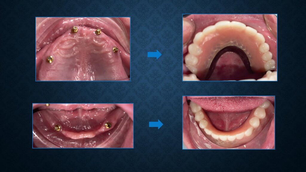 Brad before and after ceramic implants