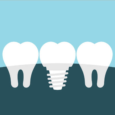 DI_set2-implant-39-400