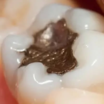Amalgam filling on tooth