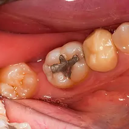 What is Amalgam Filling? Why Is It No Longer Preferred?