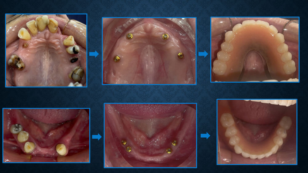 Denture before and afters