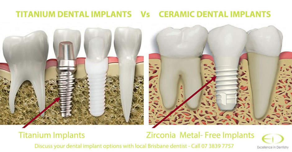 Titanium vs Ceramic Implants
