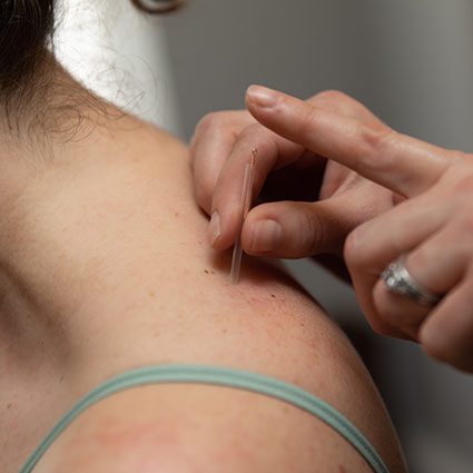 acupuncture needle in persons shoulder
