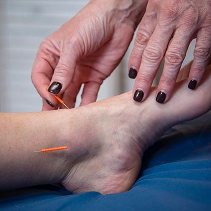 Acupuncture on feet