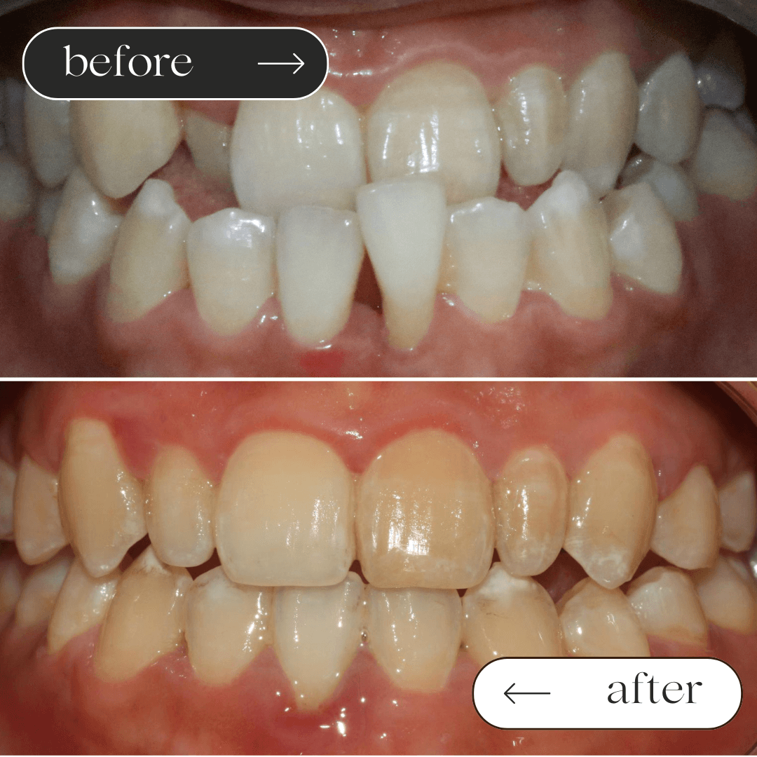 Braces before and after