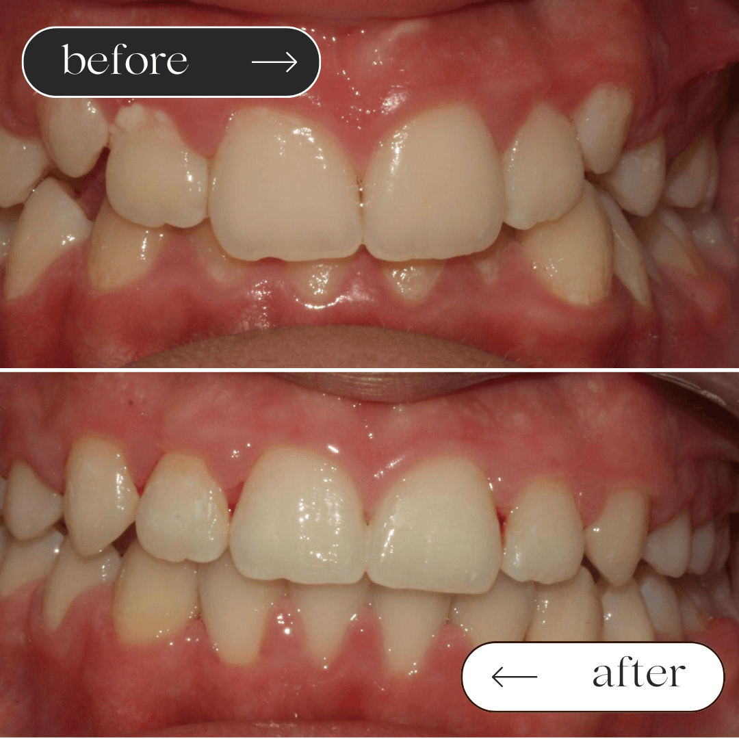 Braces before and after 2