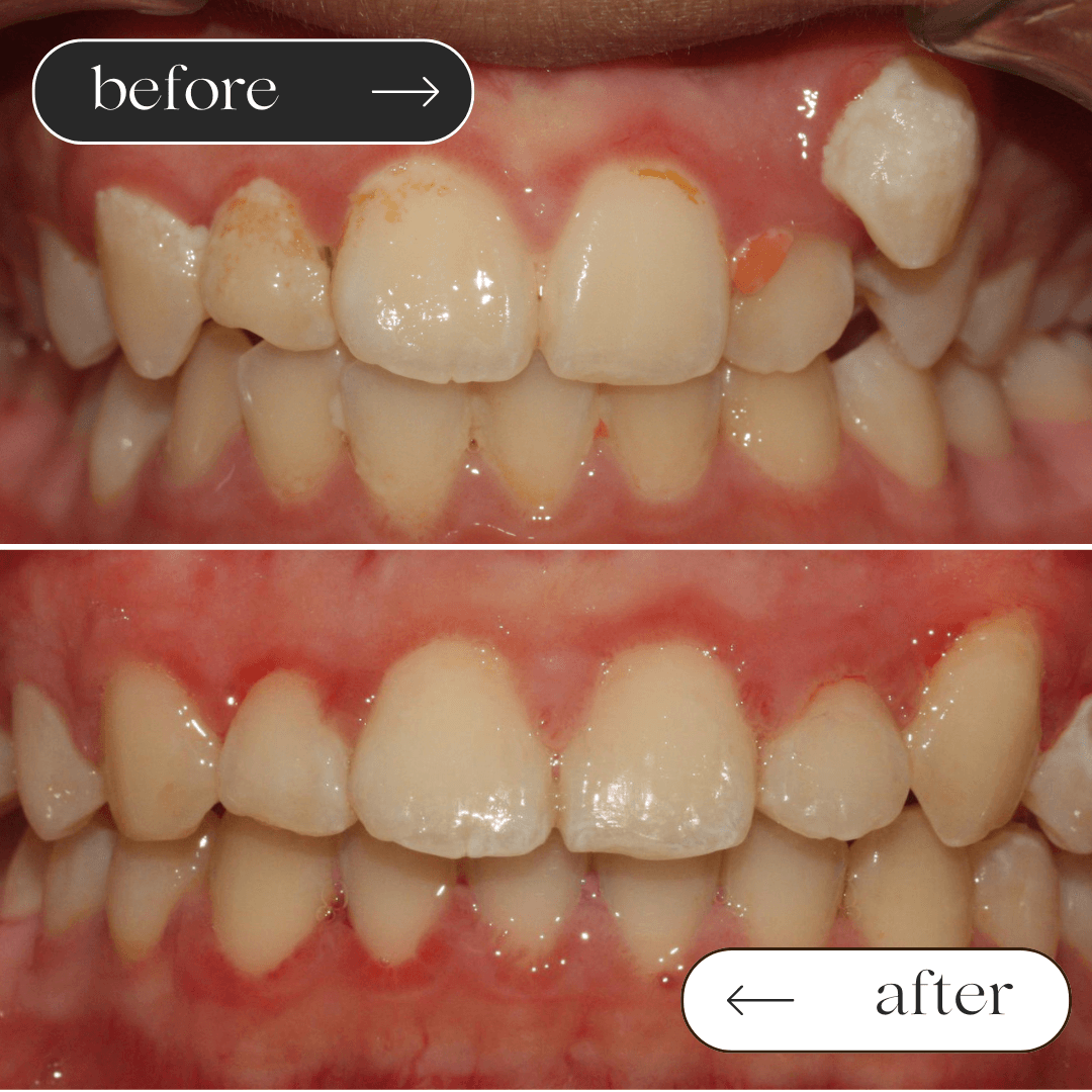 Braces before and after 3
