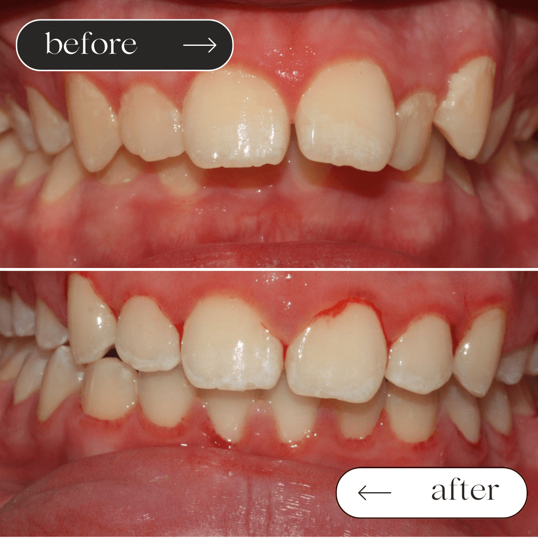 Braces before and after 4