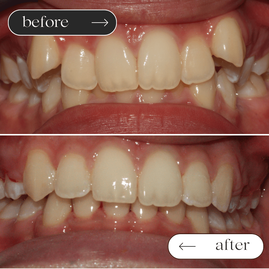 Braces before and after 5