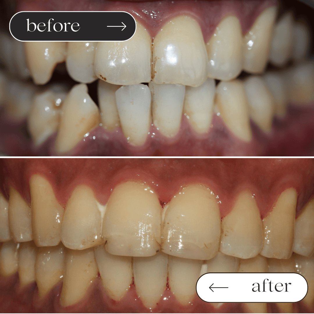 Braces before and after 6
