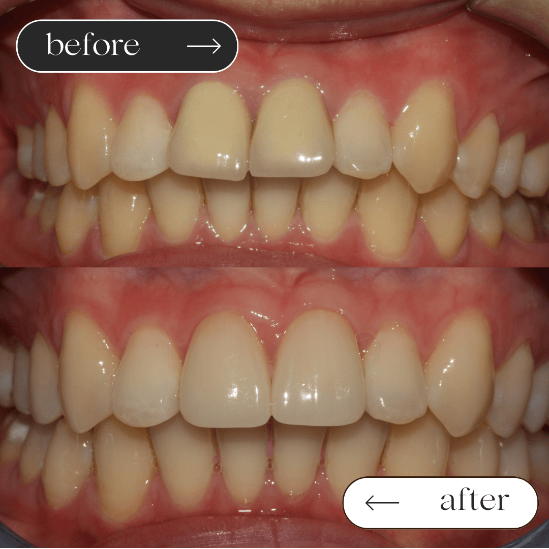 Crowns before and after