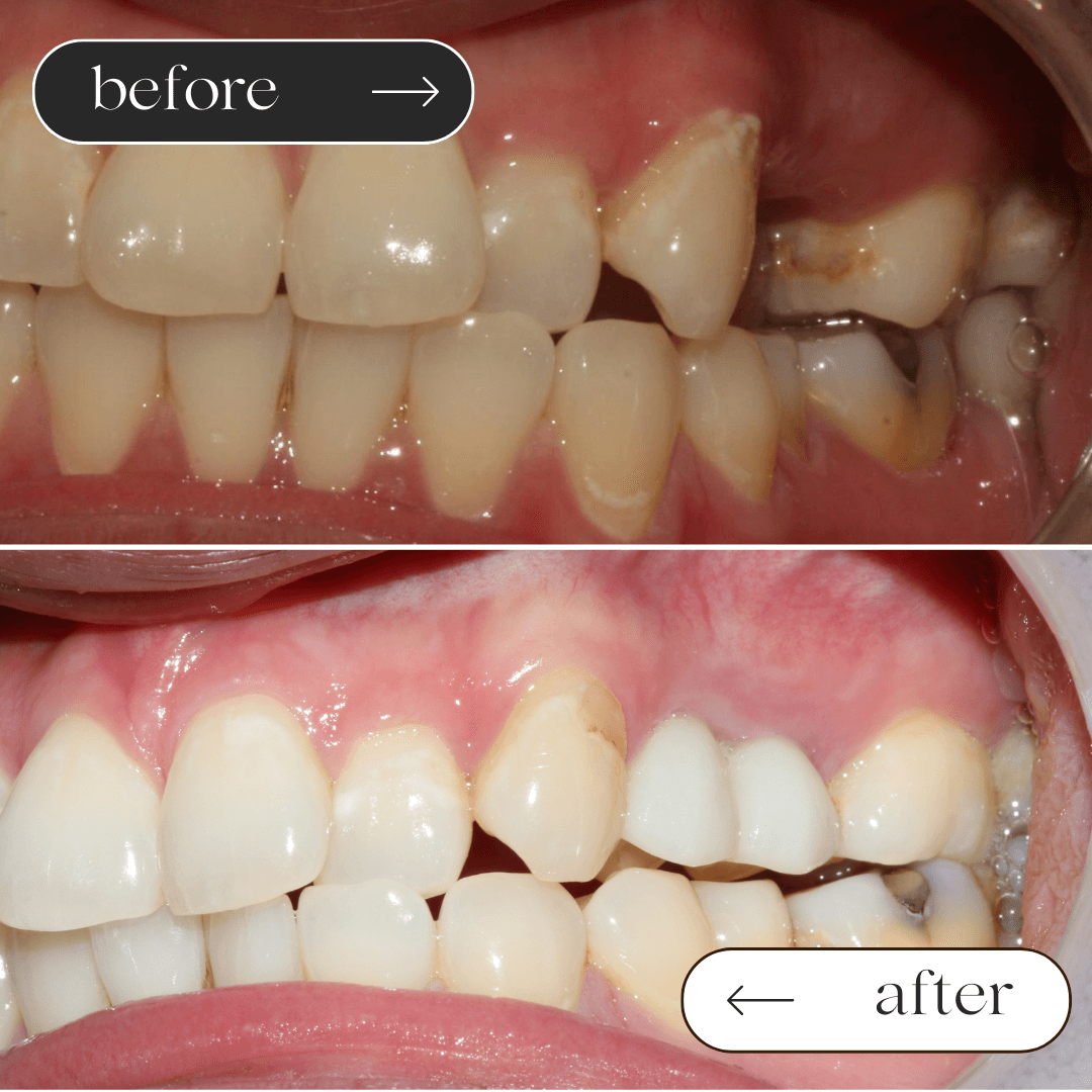 Dental Implants before and after