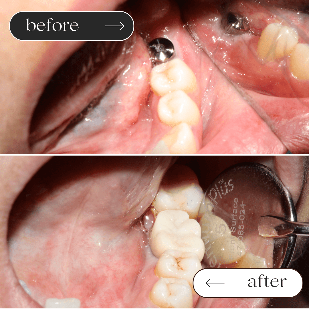 Dental Implants before and after 2