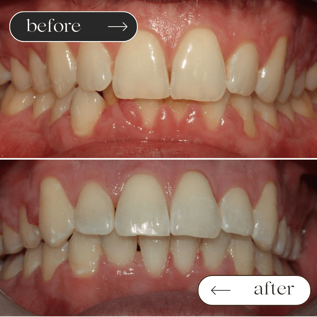 Invisalign before and after