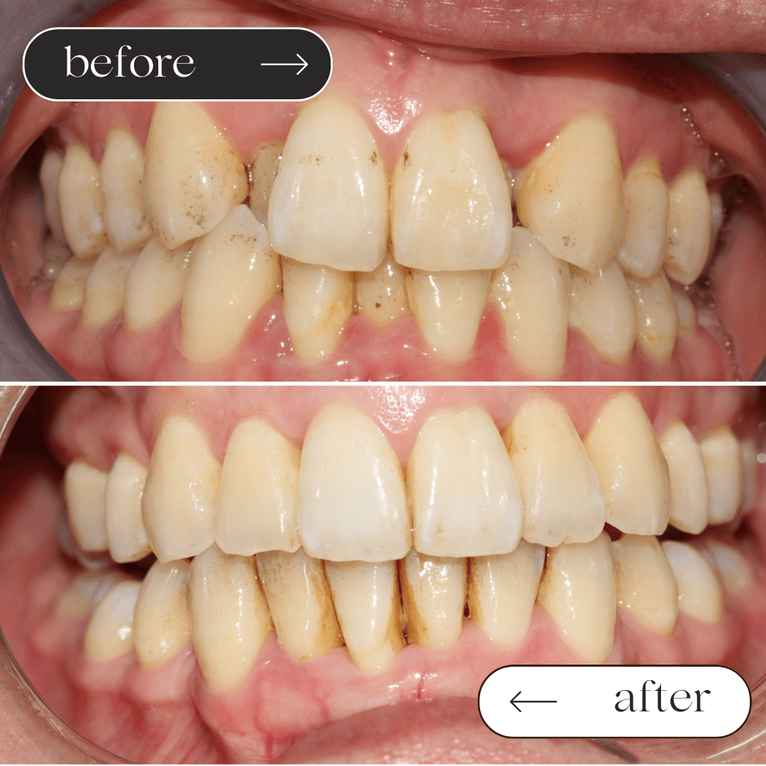 Invisalign before and after 2