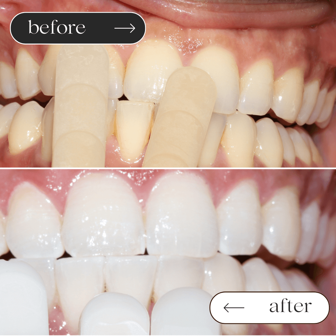 Teeth whitening before and after 6