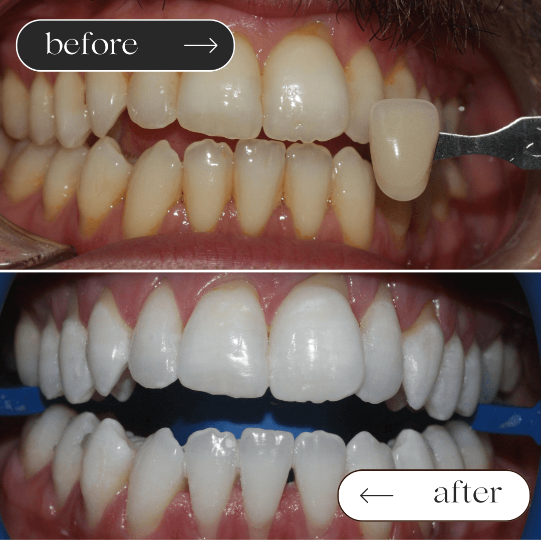 Teeth whitening before and after