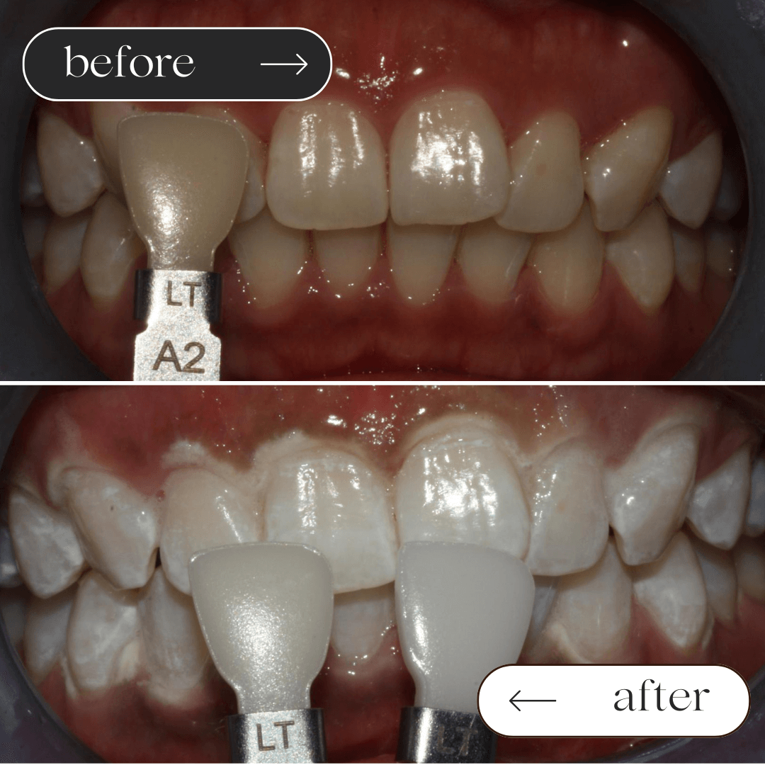 Teeth whitening before and after 2