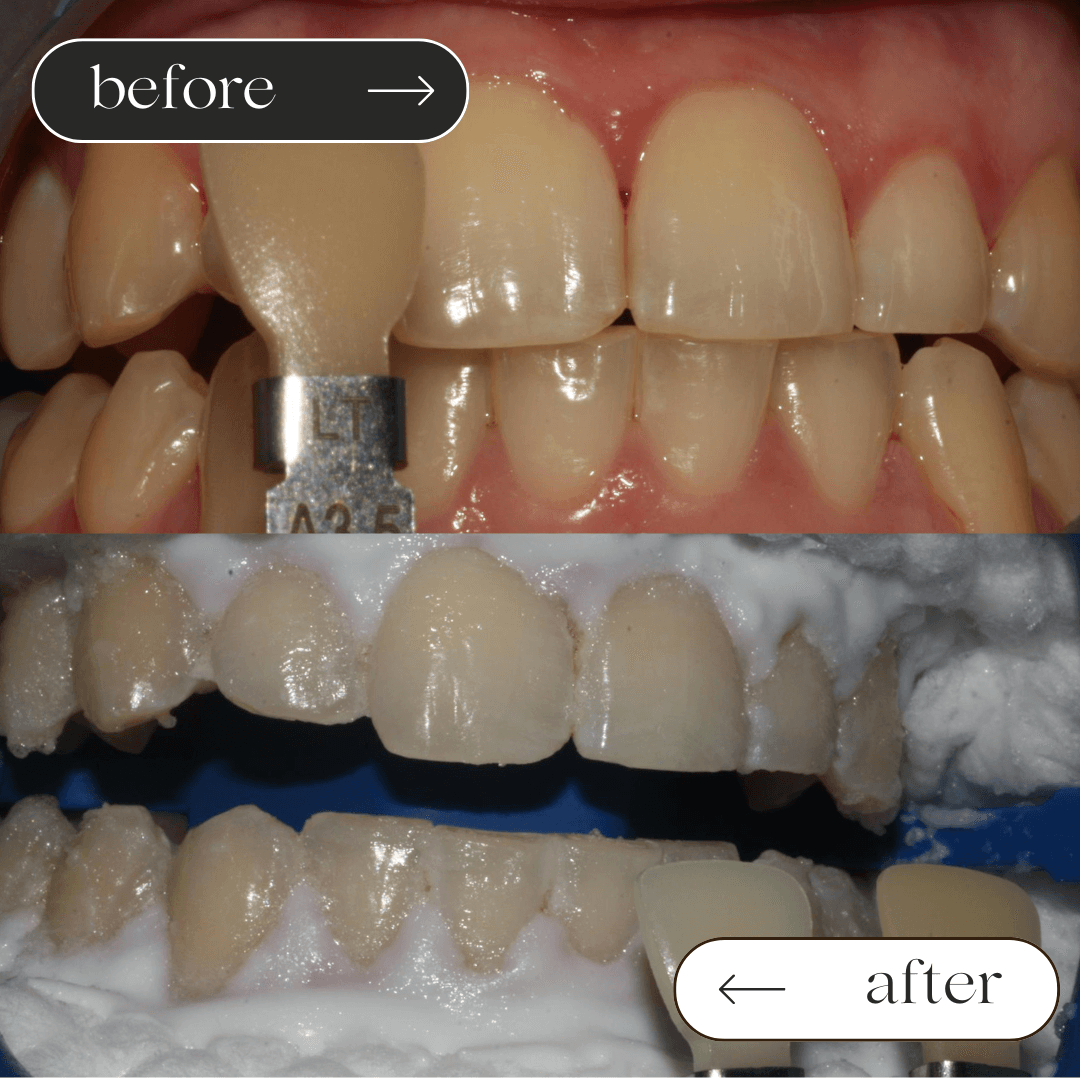 Teeth whitening before and after 3