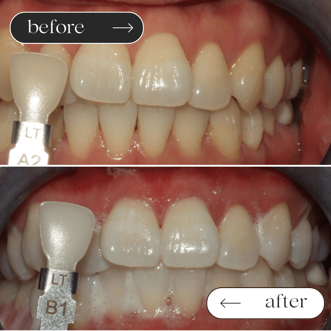 Teeth whitening before and after 4