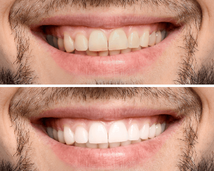 Before and after photo of dental work