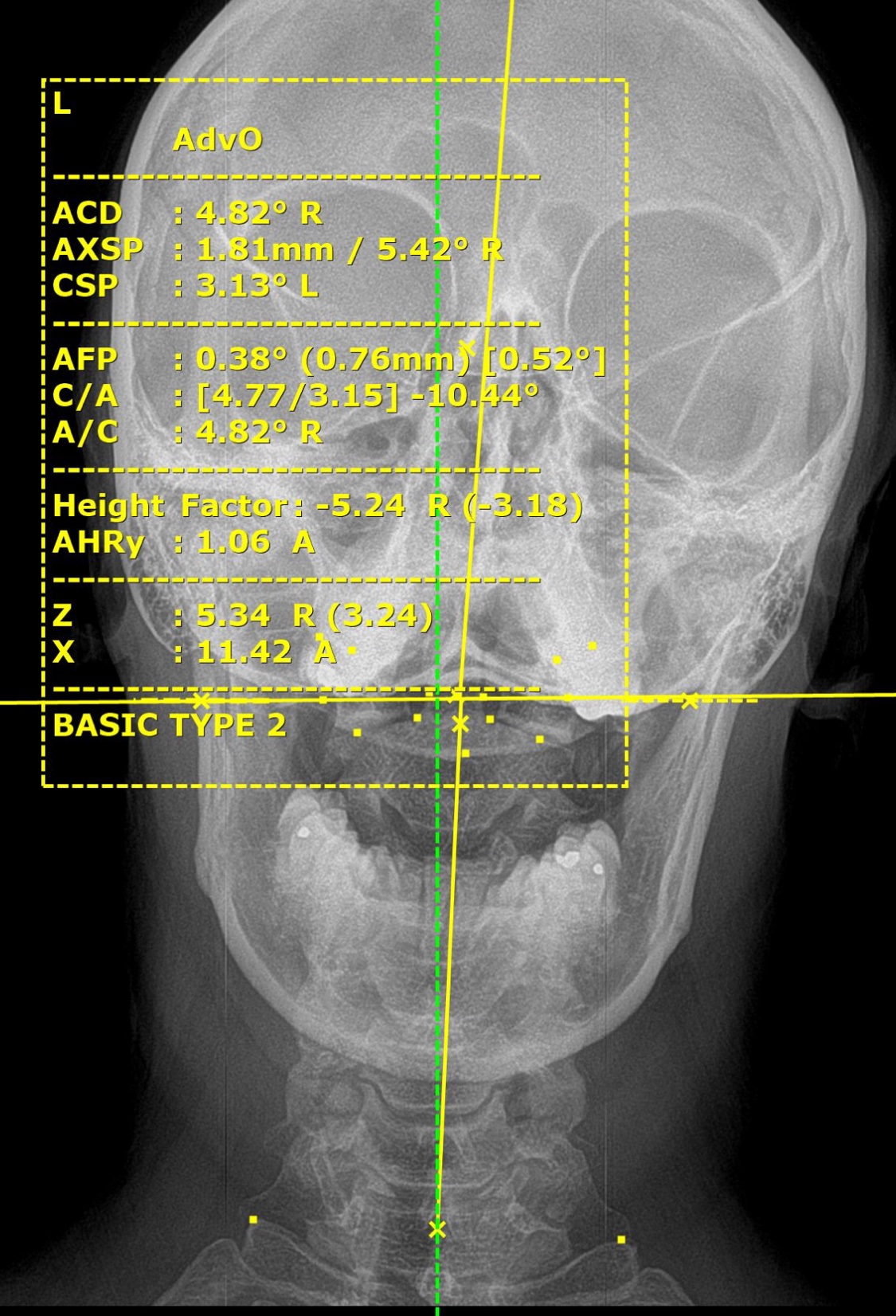 Upper Cervical X-Ray