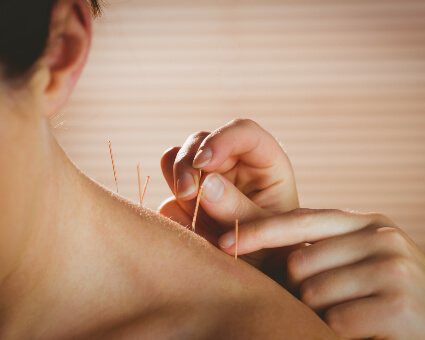 Acupuncture treatment female patient