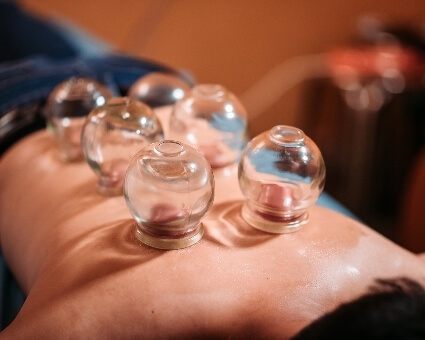 Patient being treated with cupping therapy