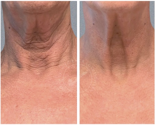 Neck before and after