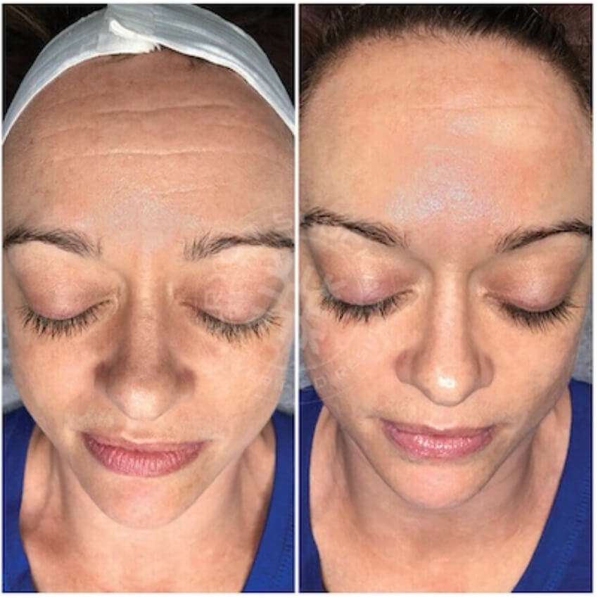 before and after cryo treatment